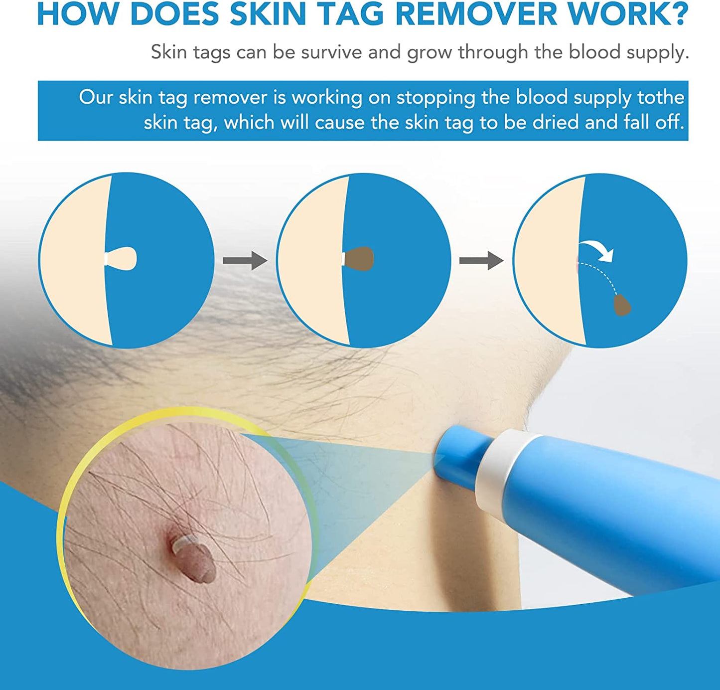 🔥Buy 2 Get Free Shipping🔥-Skin Tag Remover Set