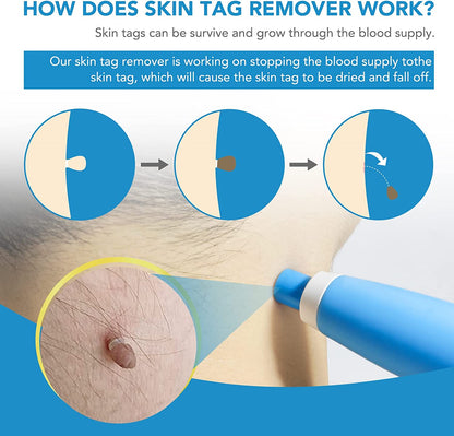 🔥Buy 2 Get Free Shipping🔥-Skin Tag Remover Set