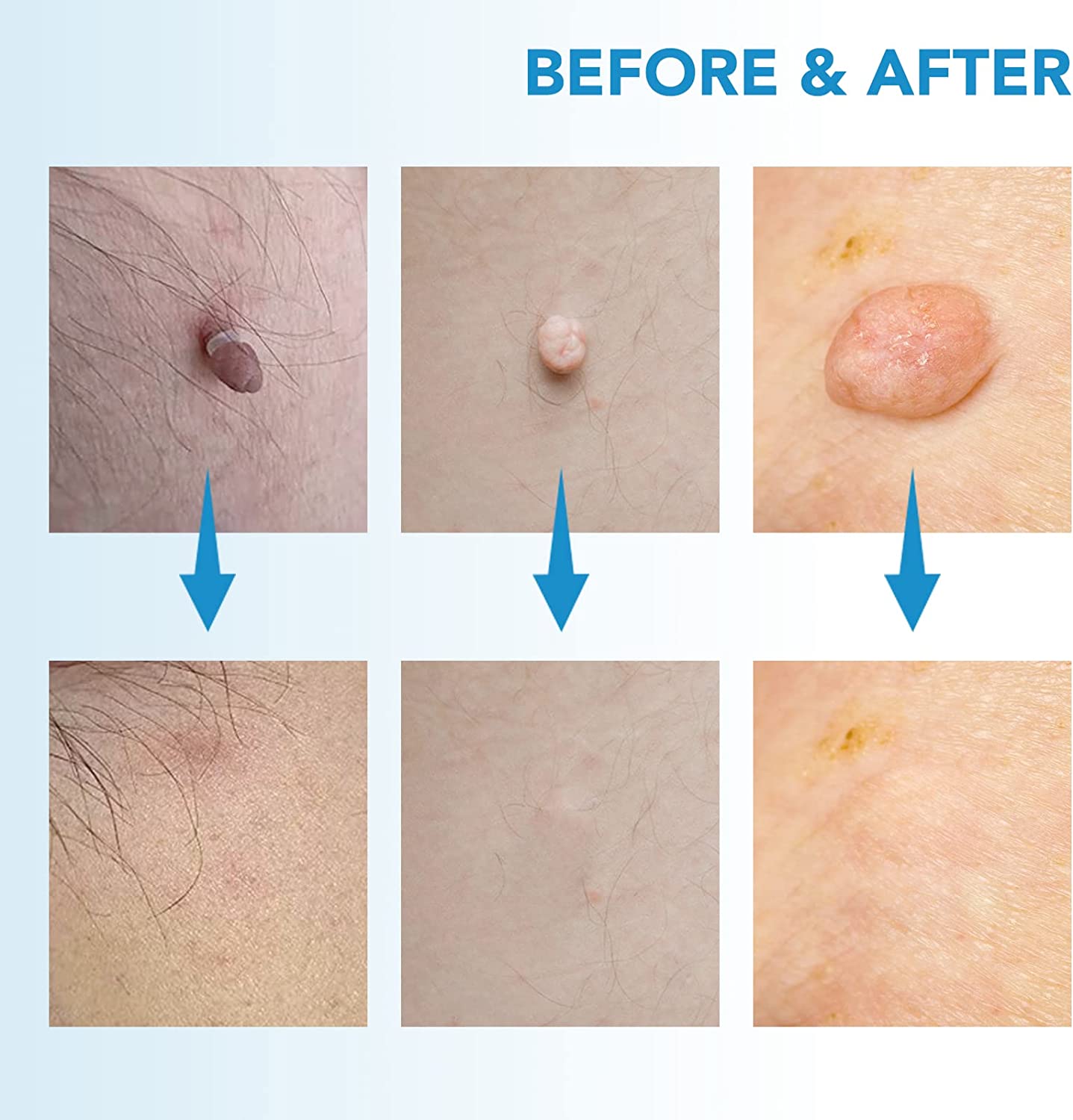 🔥Buy 2 Get Free Shipping🔥-Skin Tag Remover Set